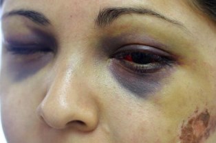 hematomas