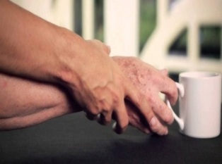 parkinson