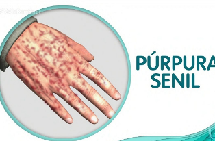 purpura
