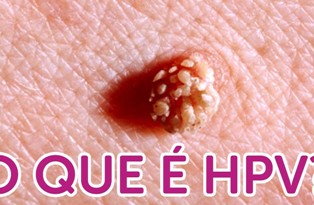 hpv