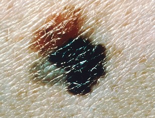 melanona