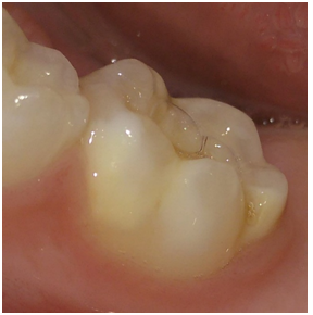 dentes