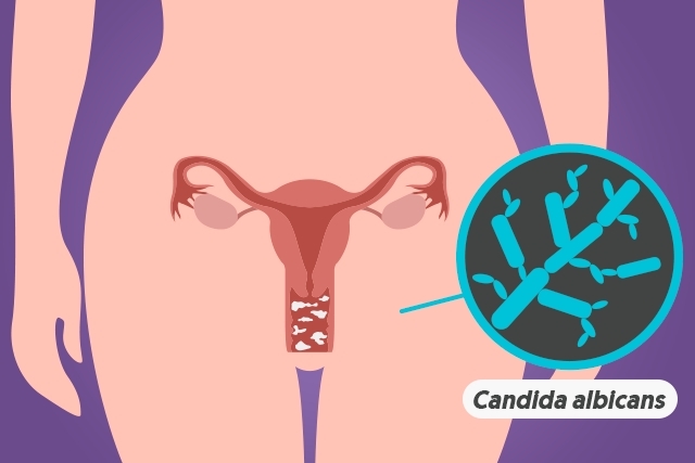 candidiase
