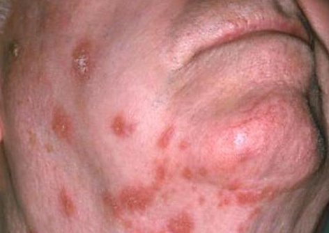 herpes