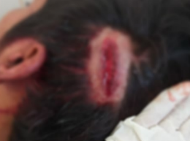 baleado