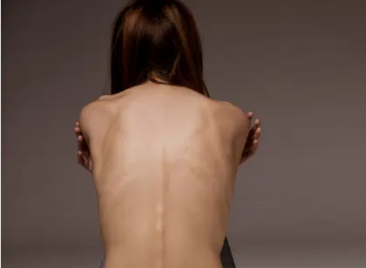 anorexia
