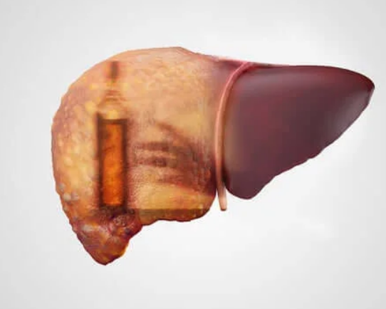 hepatite