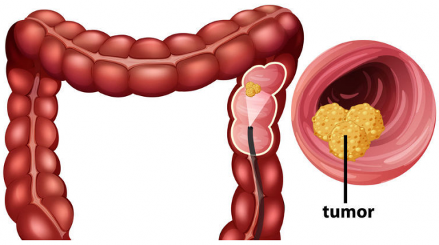 cancercoloetal