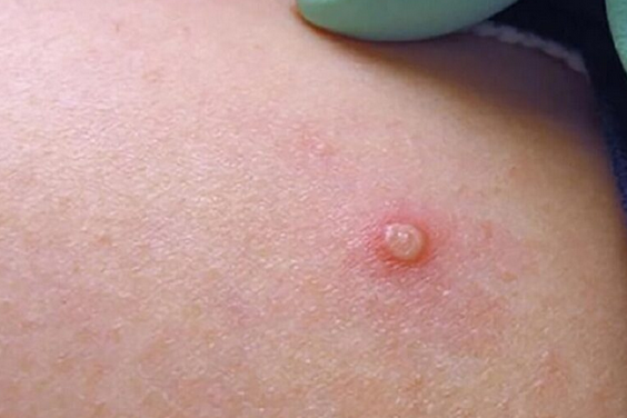 variolaa