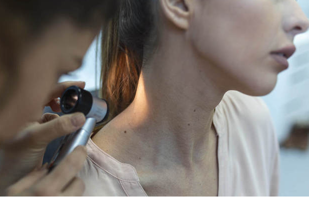melanoma
