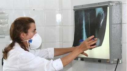 tuberculose