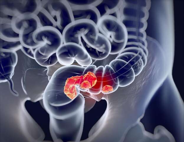 cancerintestino