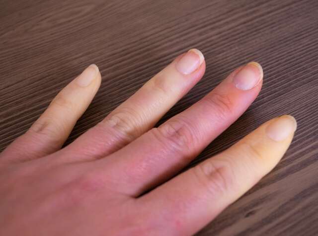 esclerodermia