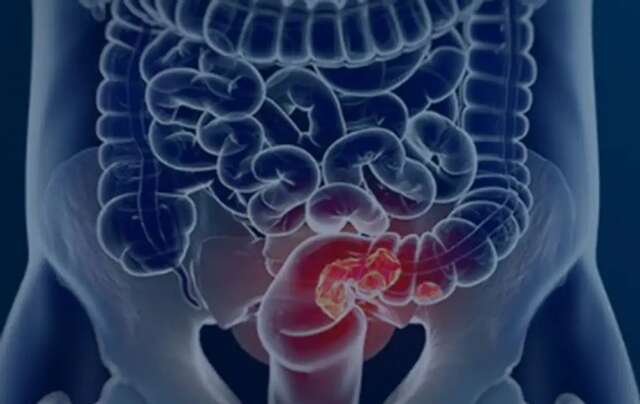 cancerintestino