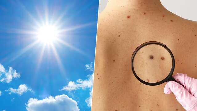 melanomas