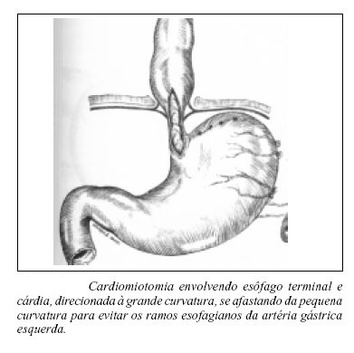 cardiomiotomia