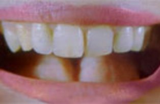 dentes