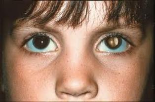 retinoblaastoma